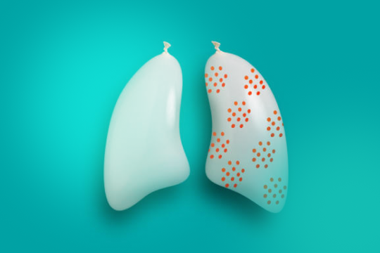 利用超音波導引方式，進行豎脊肌神經阻斷術，讓患者更快從受傷當中恢復